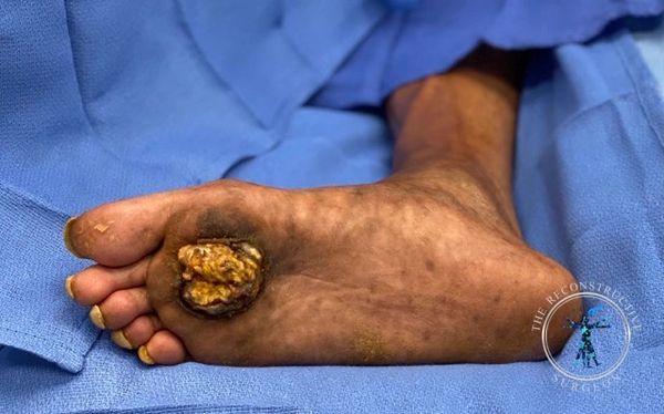Dr. John Felder treats squamous cell carcinoma of the foot