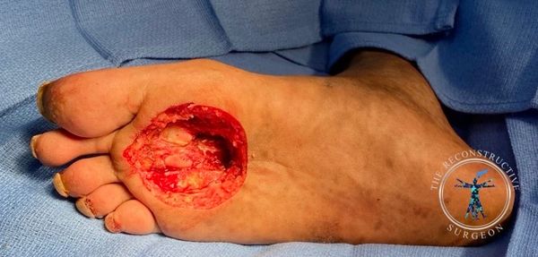 Mohs resection of foot skin cancer - Dr. Felder
