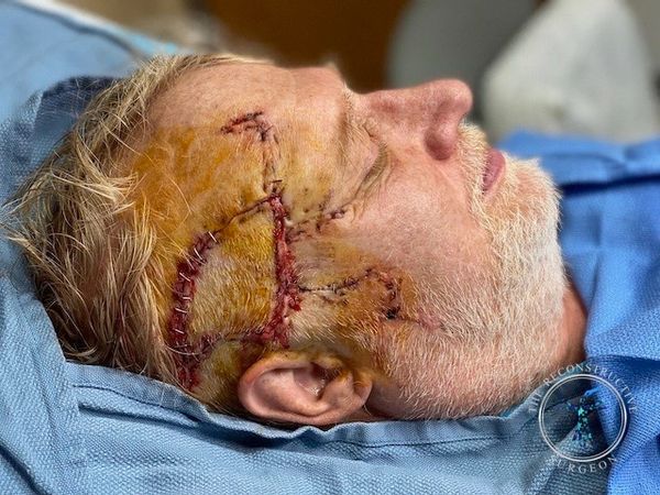 Squamous cell carcinoma of the temple treated by Dr. John Felder, Plastic Surgeon