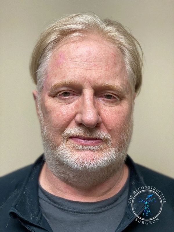 Squamous cell carcinoma of the temple treated by Dr. John Felder, Plastic Surgeon