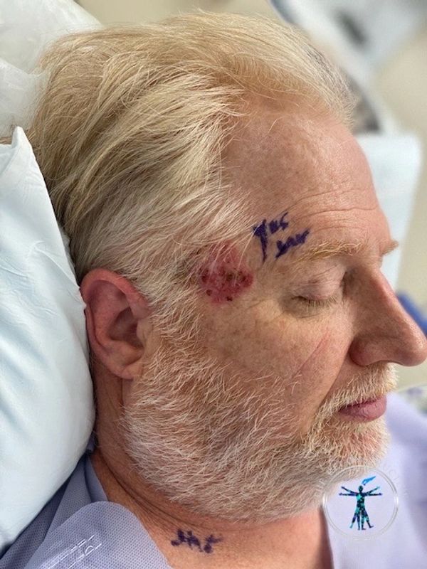 Squamous cell carcinoma of the temple treated by Dr. John Felder, Plastic Surgeon