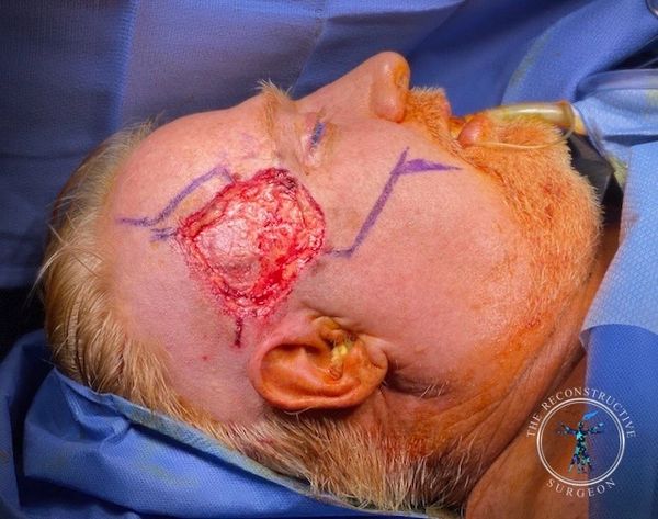 Complex squamous cell carcinoma defect  of the temple treated by Dr. John Felder, Plastic Surgeon