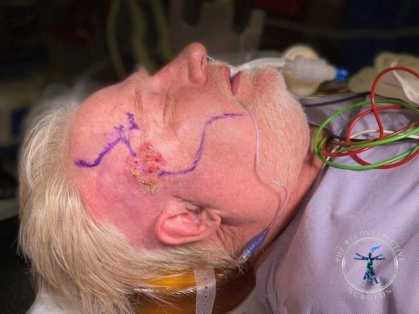 Squamous cell carcinoma of the temple treated by Dr. John Felder, Plastic Surgeon