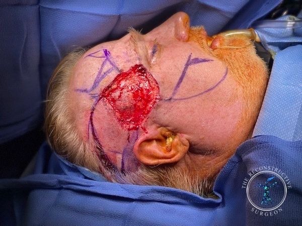 Squamous cell carcinoma of the temple treated by Dr. John Felder, Plastic Surgeon