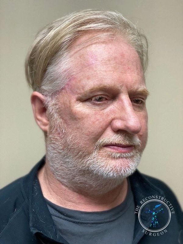 Squamous cell carcinoma of the temple treated by Dr. John Felder, Plastic Surgeon
