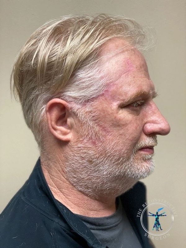 Squamous cell carcinoma of the temple treated by Dr. John Felder, Plastic Surgeon