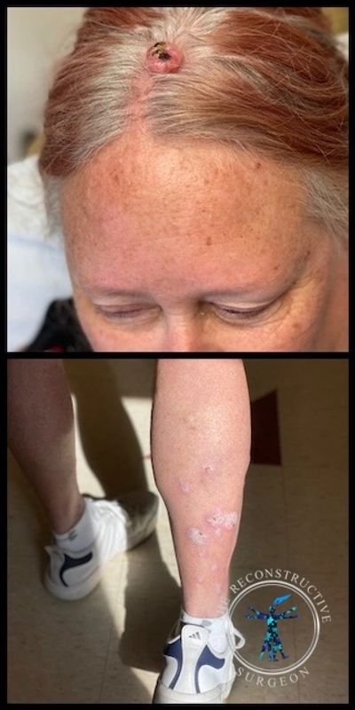 Dr John Felder treats melanoma of the scalp and squamous cell carcinoma of the leg
