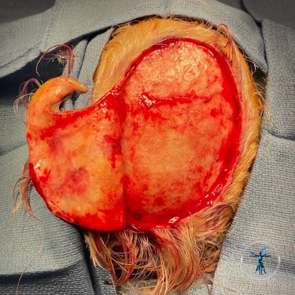 Dr. John Felder plastic surgery reconstructs skin cancer of the scalp with rotation snail flap