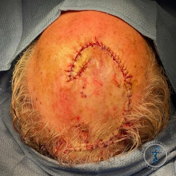 Dr. John Felder plastic surgery reconstructs skin cancer of the scalp with rotation snail flap