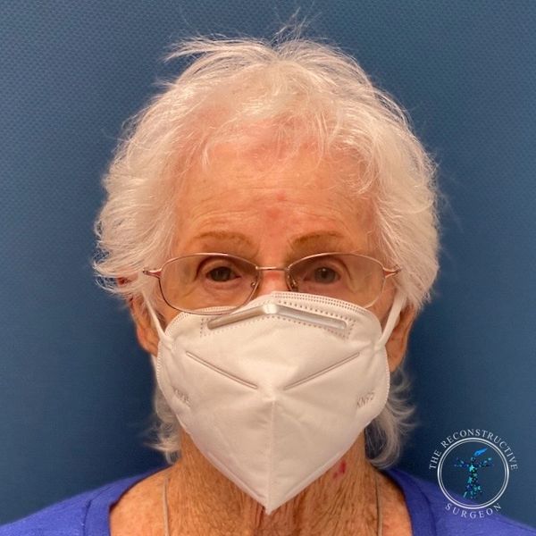 Dr. John Felder plastic surgery reconstructs skin cancer of the scalp with rotation snail flap
