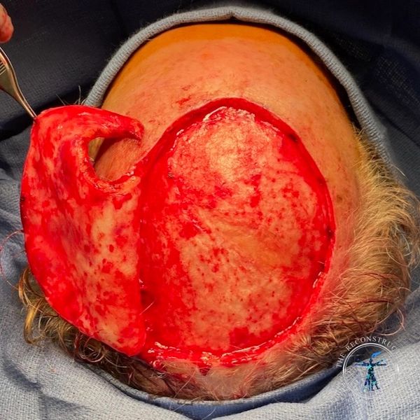 Dr. John Felder plastic surgery reconstructs skin cancer of the scalp with rotation snail flap