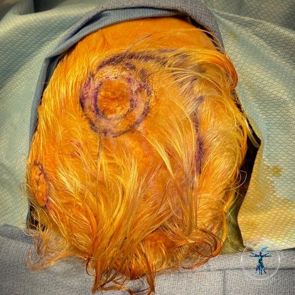 Dr. John Felder plastic surgery reconstructs skin cancer of the scalp with rotation snail flap