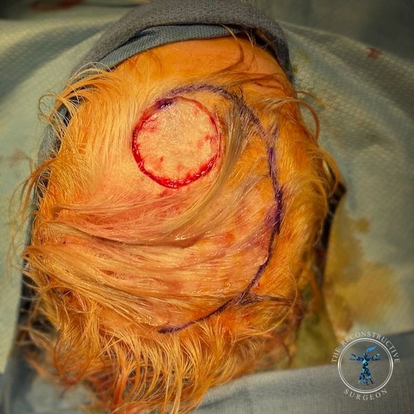 Dr. John Felder plastic surgery reconstructs skin cancer of the scalp with rotation snail flap
