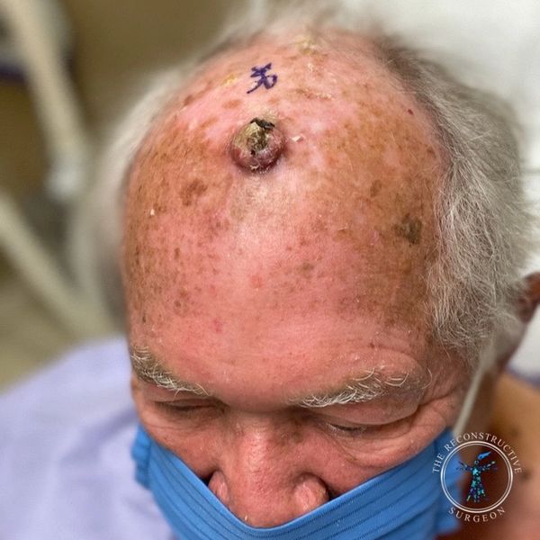 Dr. John Felder plastic surgeon reconstructs skin cancer of the scalp with rotation snail flap