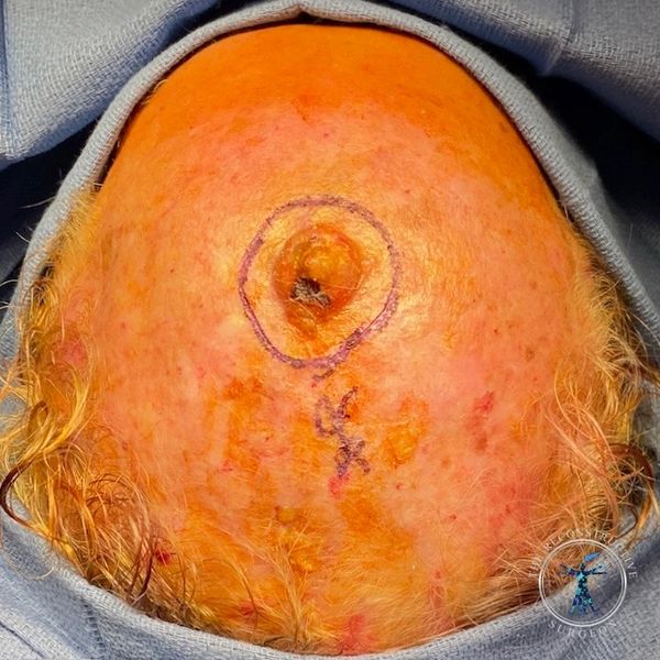 Dr. John Felder plastic surgery reconstructs skin cancer of the scalp with rotation snail flap