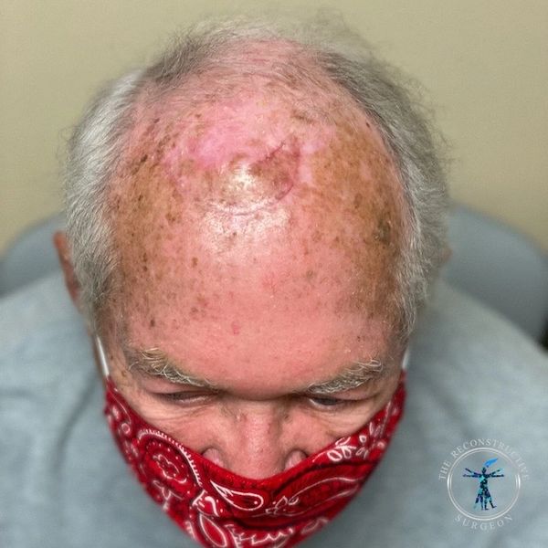 Dr. John Felder plastic surgery reconstructs skin cancer of the scalp with rotation snail flap
