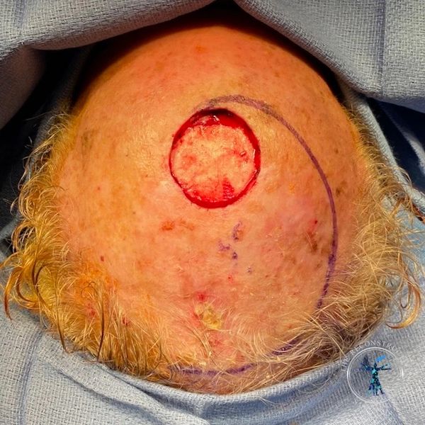 Dr. John Felder plastic surgery reconstructs skin cancer of the scalp with rotation snail flap