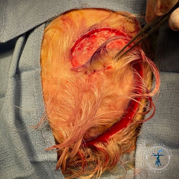 Dr. John Felder plastic surgery reconstructs skin cancer of the scalp with rotation snail flap