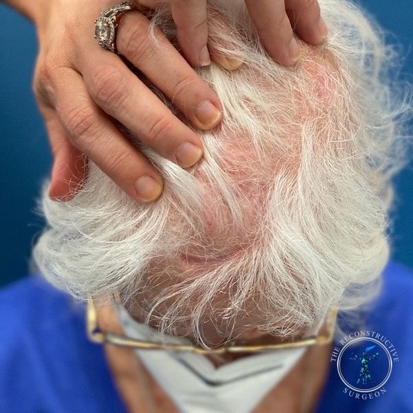 Dr. John Felder plastic surgery reconstructs skin cancer of the scalp with rotation snail flap