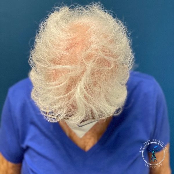 Skin cancer Mohs reconstruction of the scalp