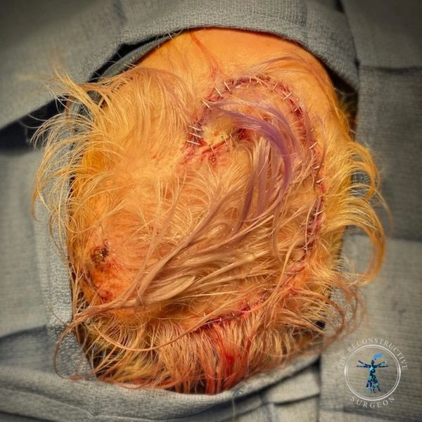 Dr. John Felder plastic surgery reconstructs skin cancer of the scalp with rotation snail flap
