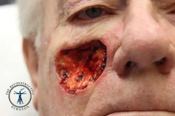 Dr. John Felder reconstructs basal cell skin cancer of the cheek after Mohs surgery before and after