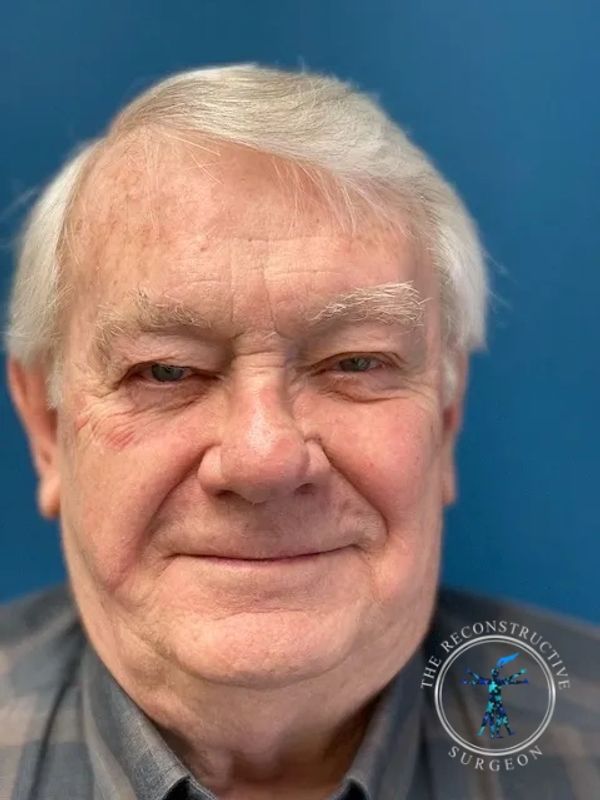 Dr. John Felder reconstructs basal cell skin cancer of the cheek after Mohs surgery before and after