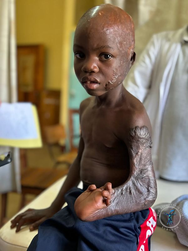 African child with severe burn scar contracture of the arm and hand treated by Dr. Felder 