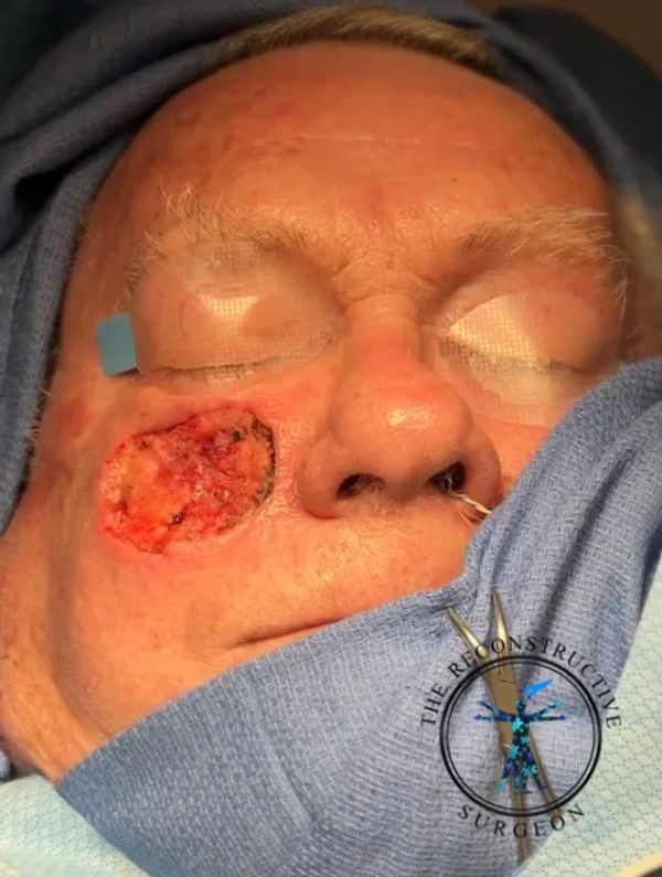 Dr. John Felder reconstructs basal cell skin cancer of the cheek after Mohs surgery before and after