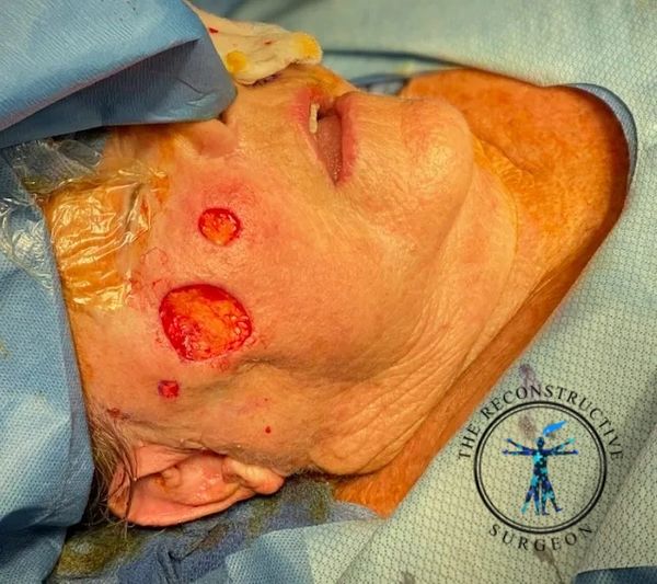 Dr. John Felder treats melanoma and squamous cell  skin cancer of the cheek before and after