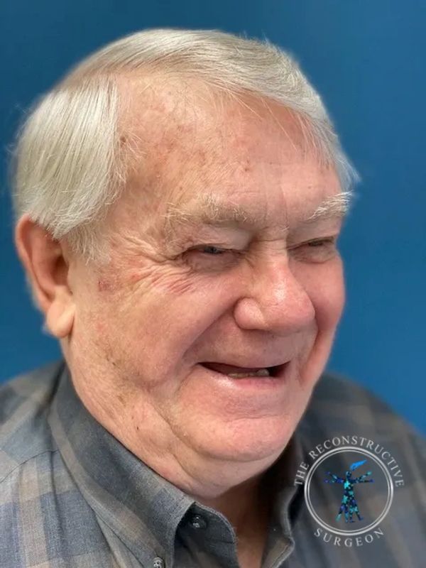 Dr. John Felder reconstructs basal cell skin cancer of the cheek after Mohs surgery before and after