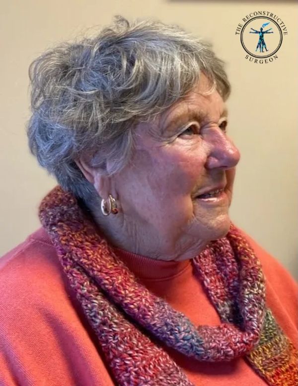 Dr. John Felder treats melanoma and squamous cell  skin cancer of the cheek before and after