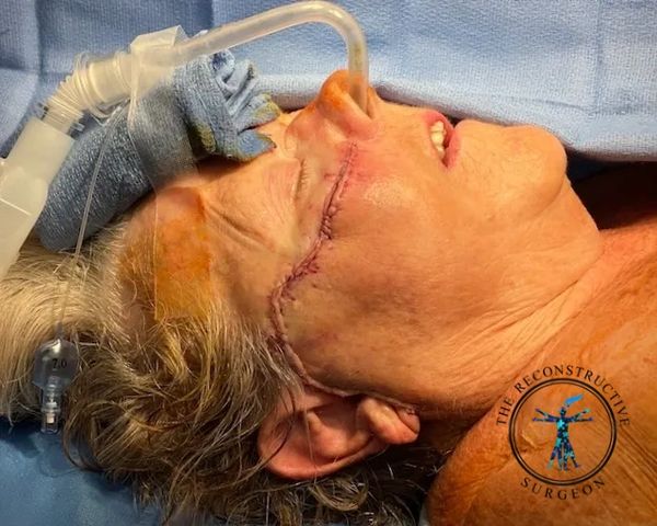 Dr. John Felder treats melanoma and squamous cell  skin cancer of the cheek before and after