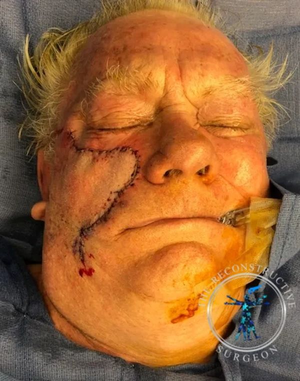Dr. John Felder reconstructs basal cell skin cancer of the cheek after Mohs surgery before and after