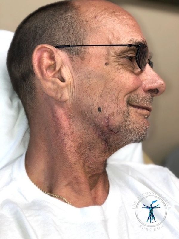 The Reconstructive Surgeon -  Dr. John Felder  plastic surgeon treats skin cancer of the neck