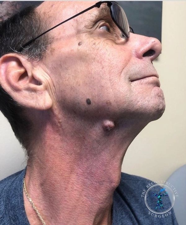 The Reconstructive Surgeon -  Dr. John Felder  plastic surgeon treats skin cancer of the neck
