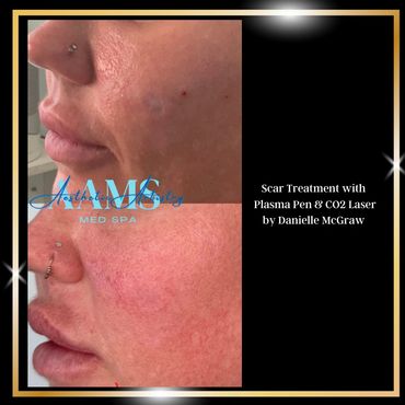 Before and after scar treatment using Plasma Pen and CO2 Laser.
