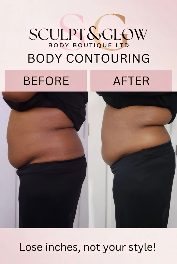 Before and after images showing body contouring results at Sculpt & Glow.