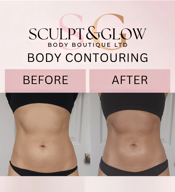 Before and after photos showing body contouring results from Sculpt & Glow.