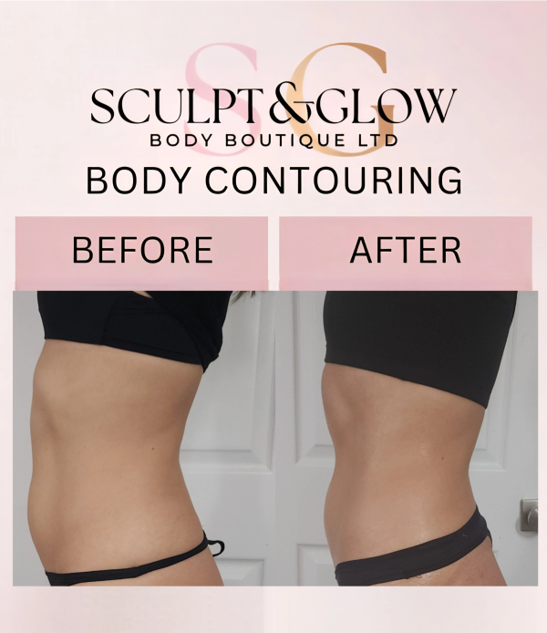 Before and after body contouring results showing a slimmer waist.