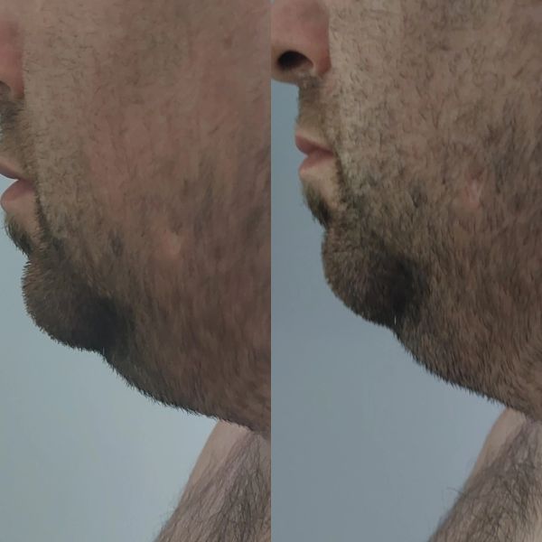 Double Chin Treatment