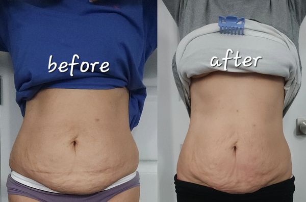 FAT REDUCTION + SKIN TIGHTENING