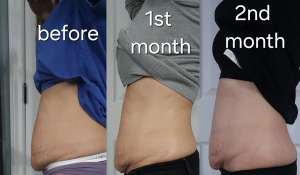 Fat reduction + skin tightening