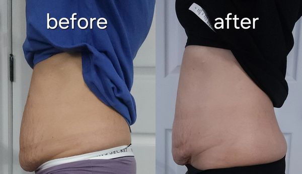 FAT REDUCTION + SKIN TIGHTENING