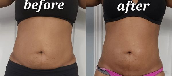 2 body sculpting Session + 1 virtual Mesotherapy session