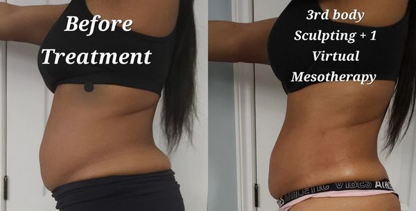 3rd body sculpting + 1 artichoke virtual meso therapy