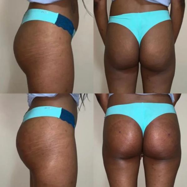 Non invasive buttlift