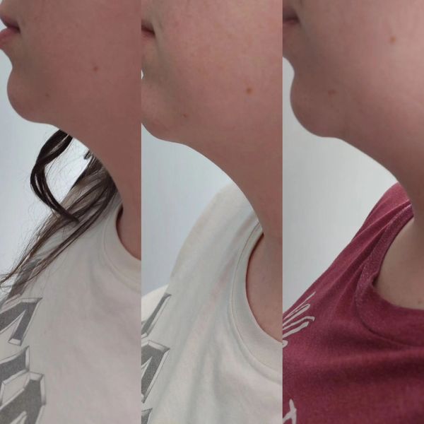 Double chin treatment