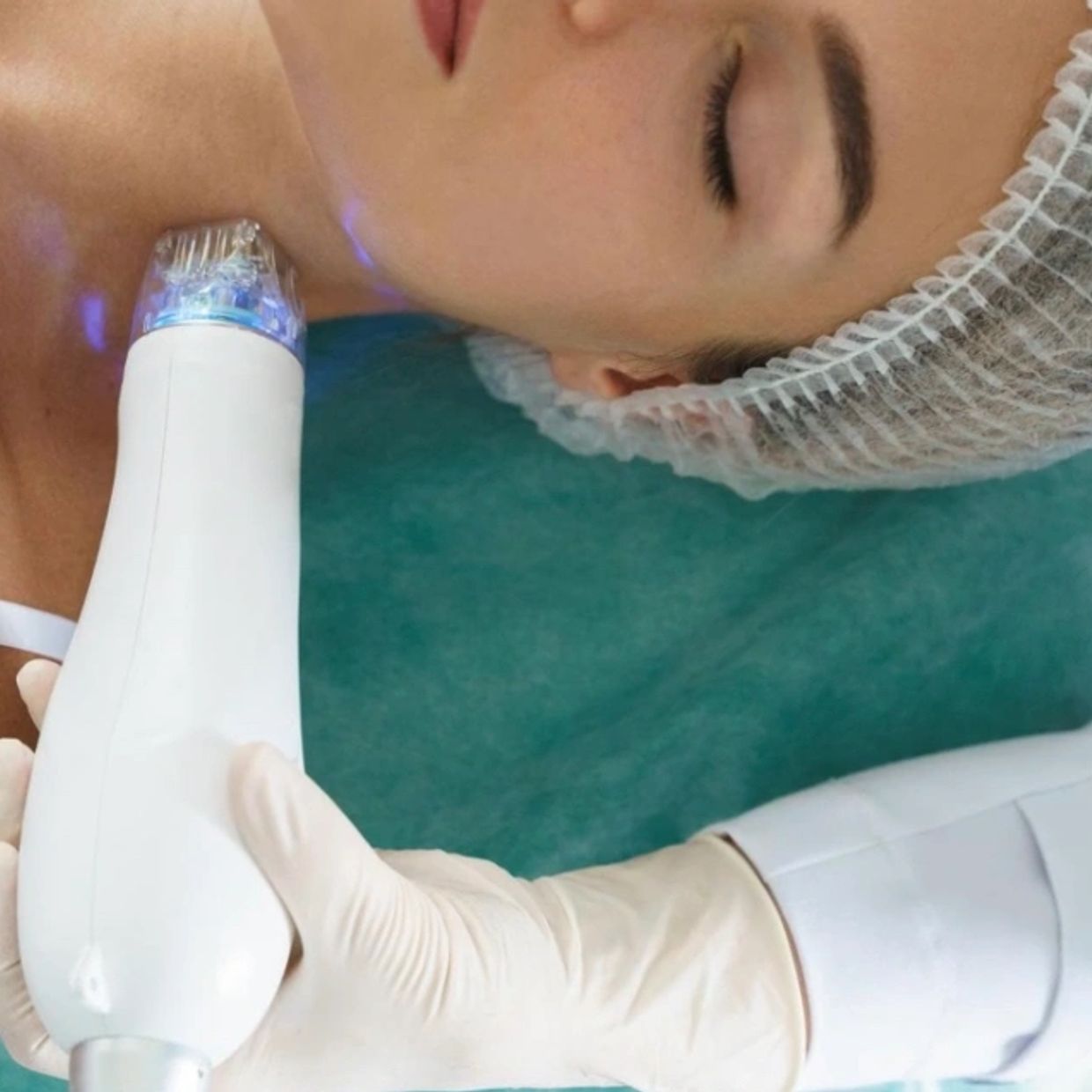 Microdermabrasion
