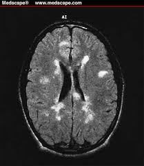 MS-Brain_MRI SCan